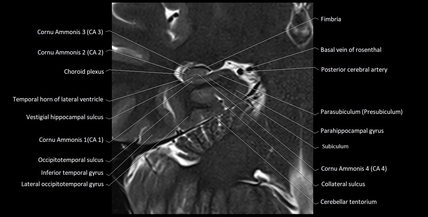 Hippocampus anatomy mri coronal cross section 3T MRI image 11.webp